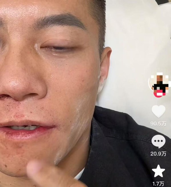 顺配宝 中国选手现身世界扇耳光大赛倒地受伤！本人回应：没有脑震荡